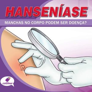 Hanseníase: As manchas no corpo podem ser doença?