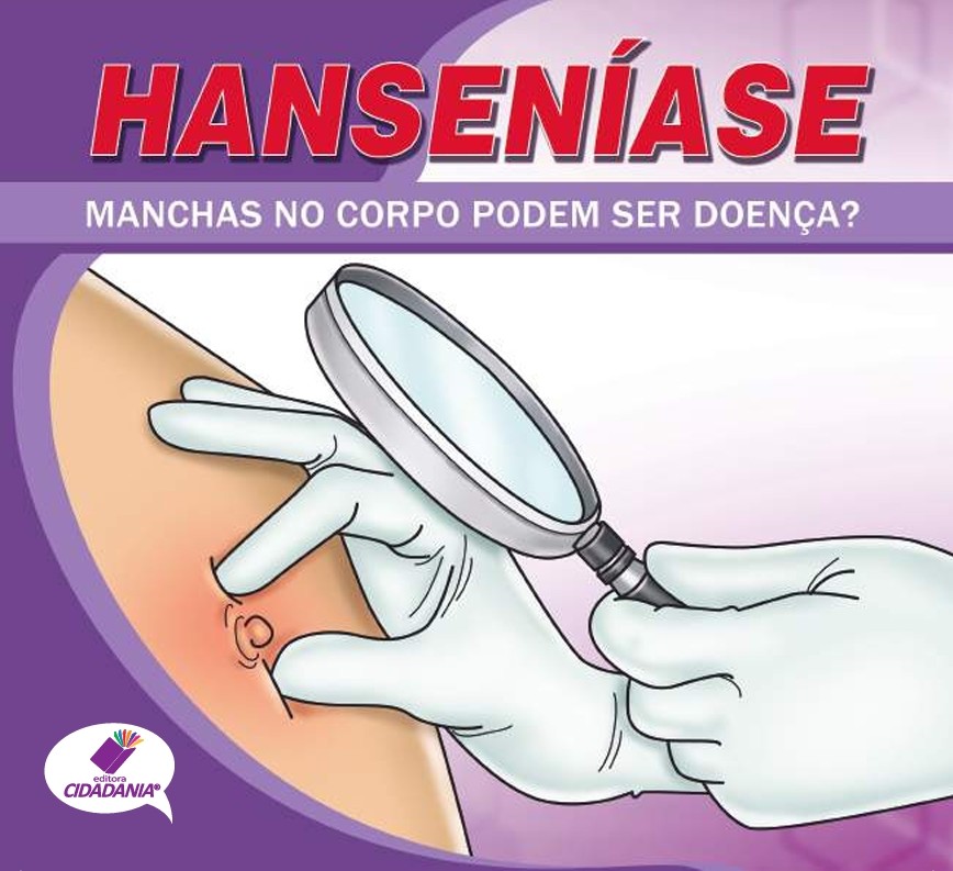 Hanseníase: As manchas no corpo podem ser doença?